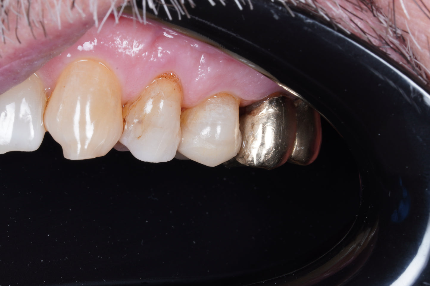 Contraste dental flexible posterior negro - Silicona suave