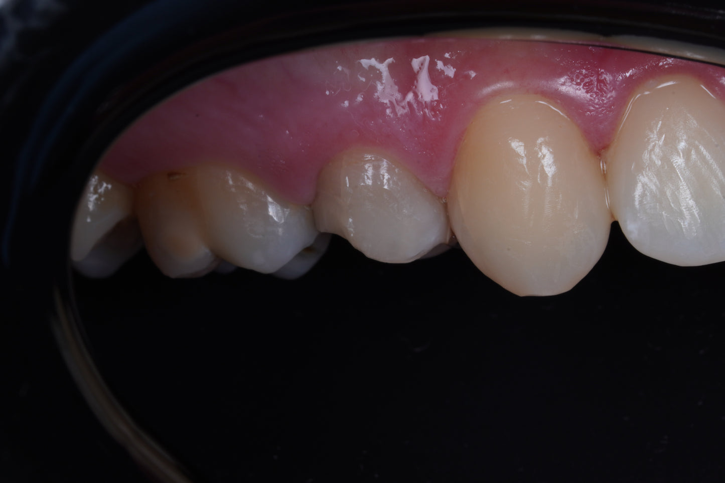 Contraste dental flexible posterior negro - Silicona suave