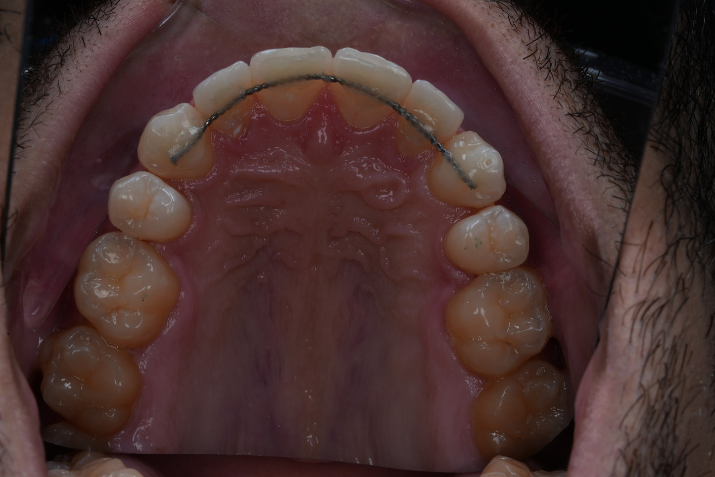 Espejos oclusales de doble cara para fotografía dental con revestimiento de titanio